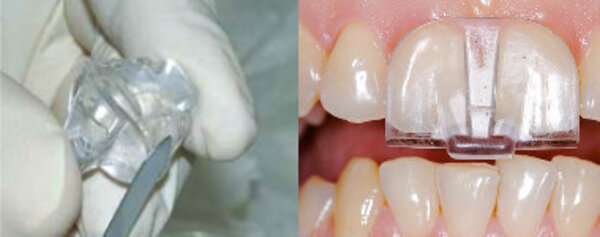 NTI-TSS Knarsbitje - Splint