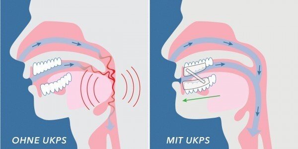 Snurkbeugel Snurkbeugel
