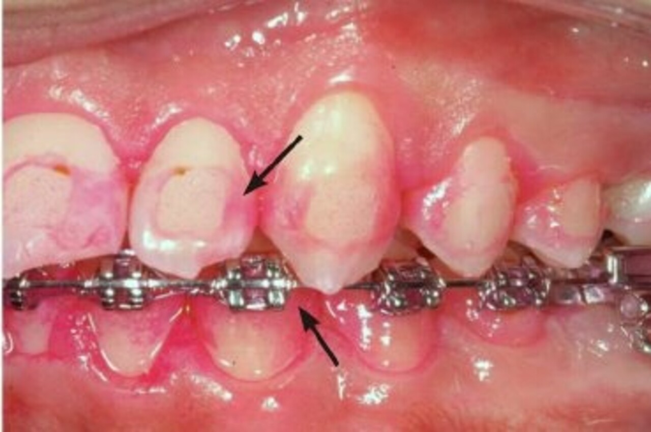 Red Cote Plakverklikkers - 12 stuks Red Cote Plakverklikkers - 12 stuks