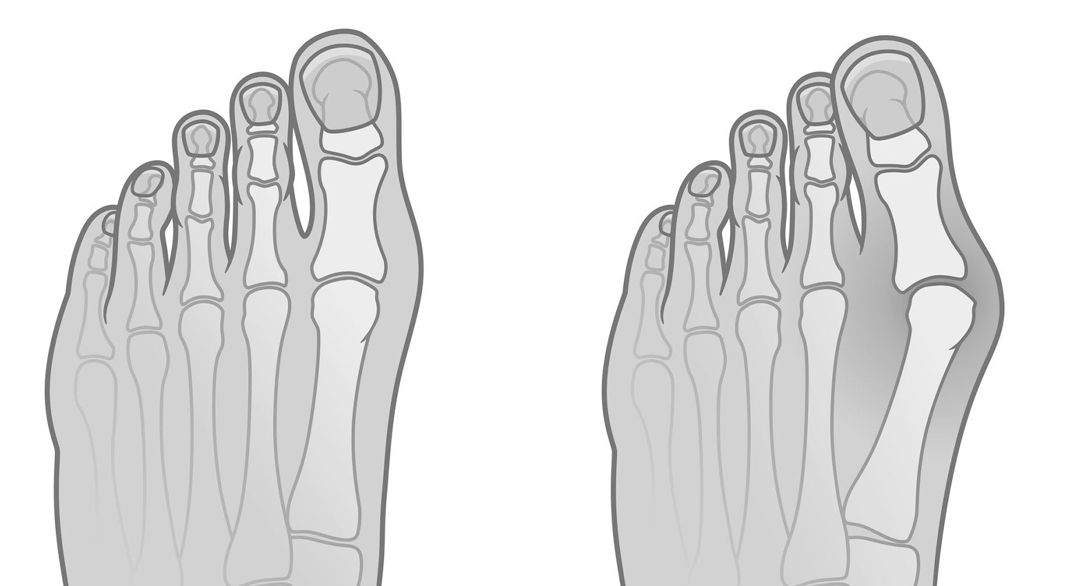 voet met hallux valgus