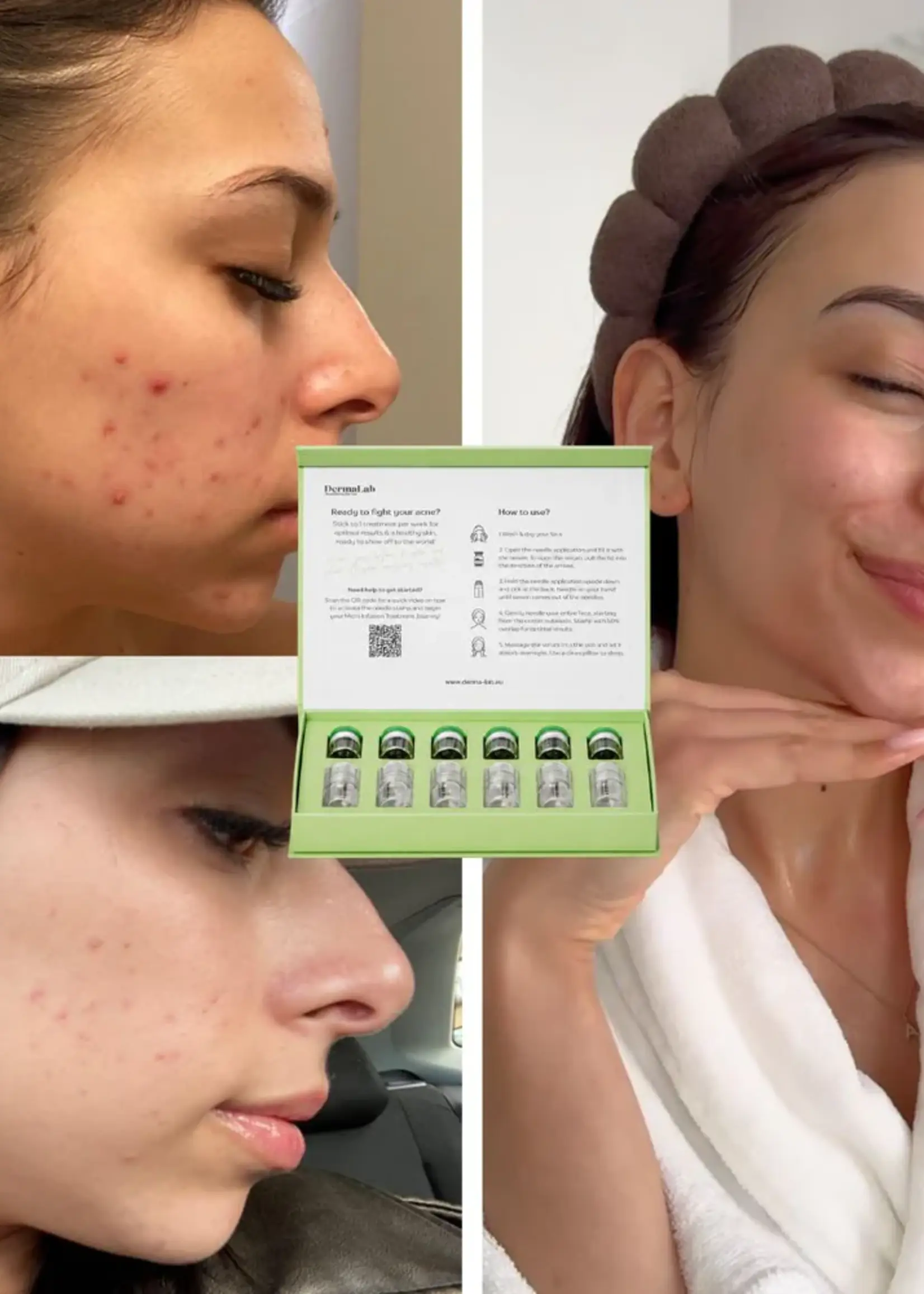 DermaLab Acne Infusion
