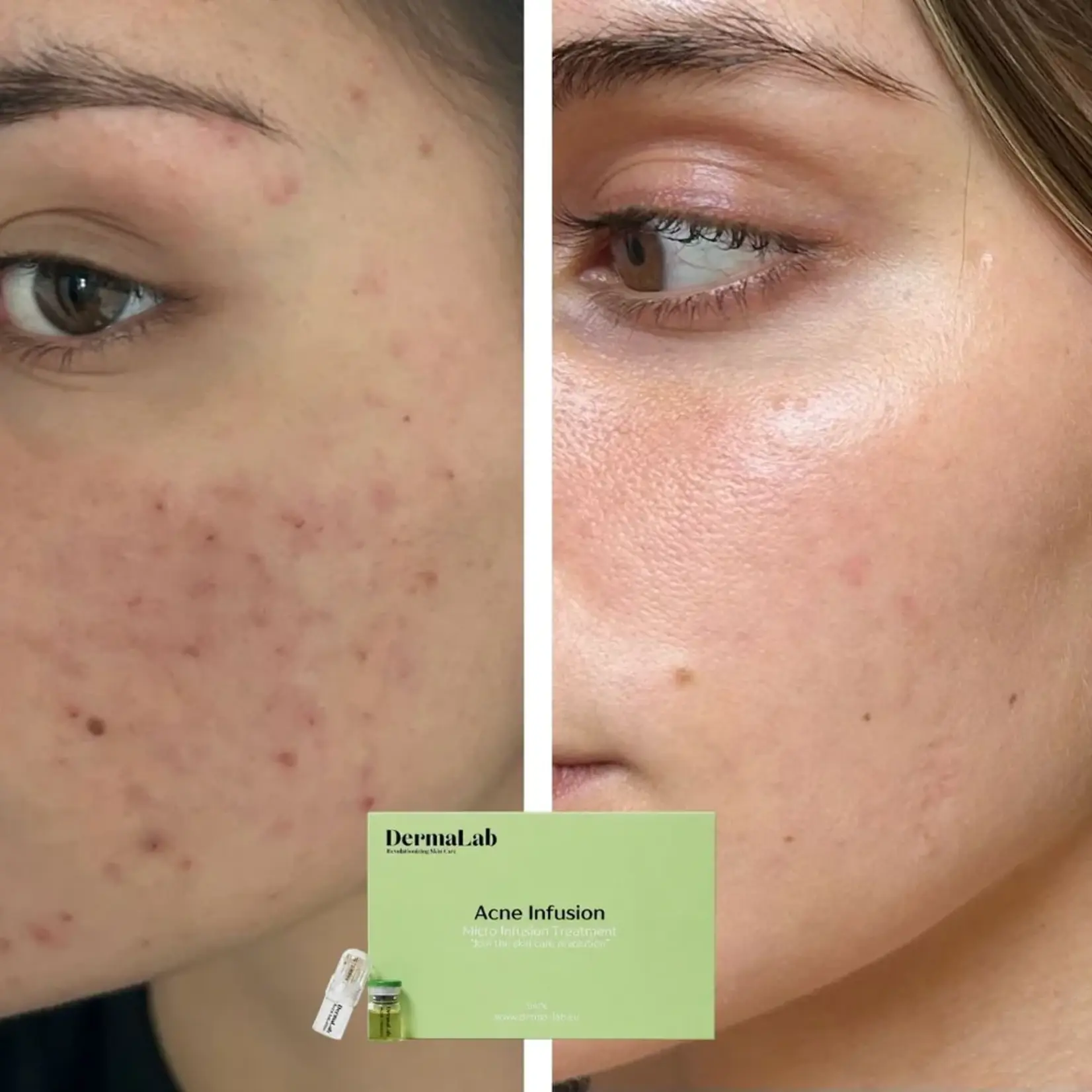DermaLab Acne Infusion