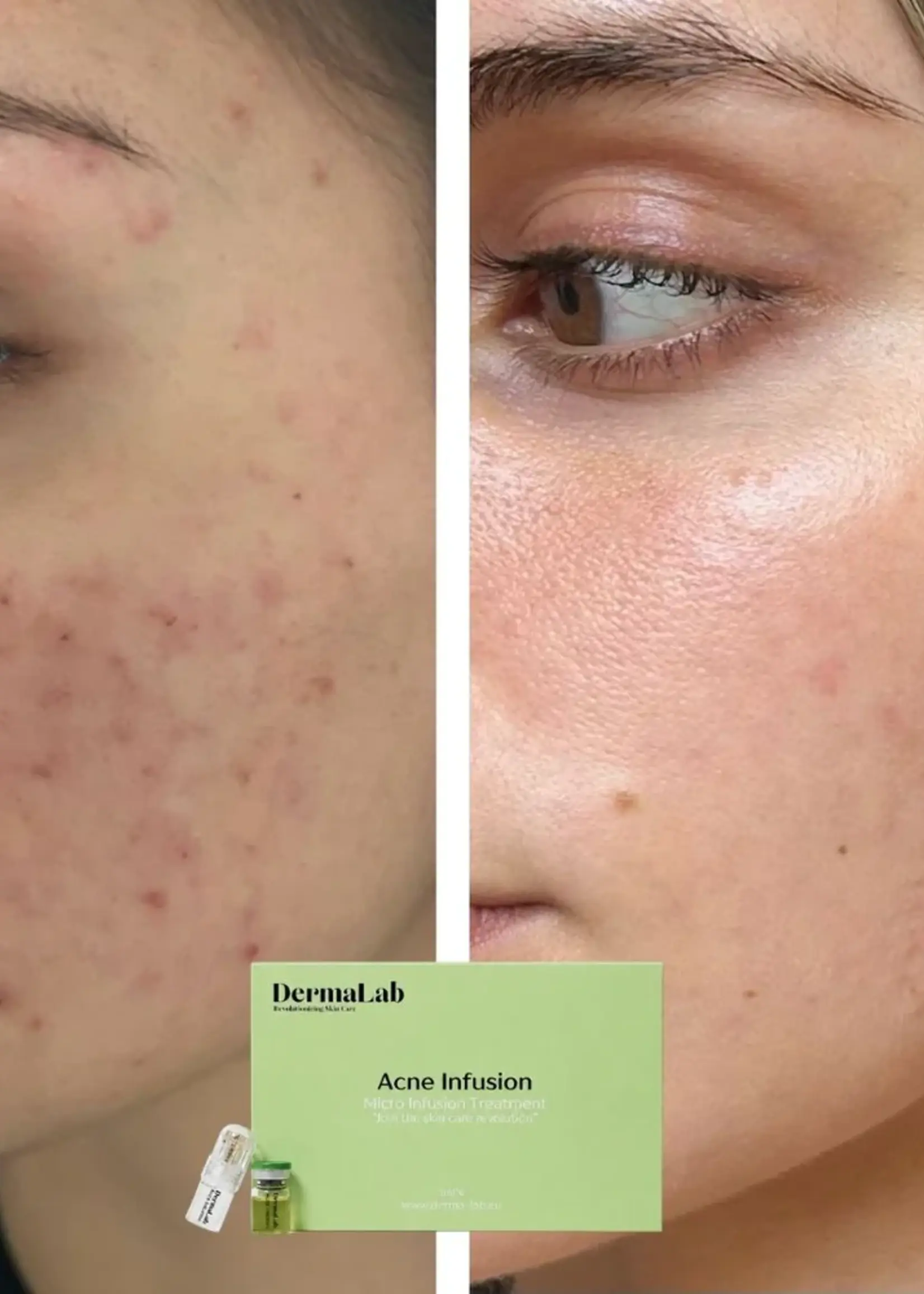 DermaLab Acne Infusion