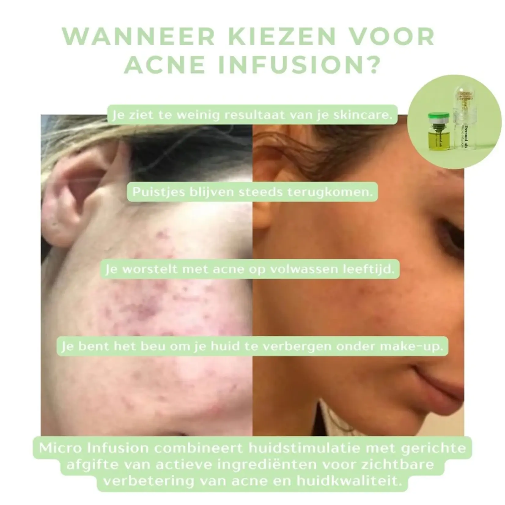DermaLab Acne Infusion