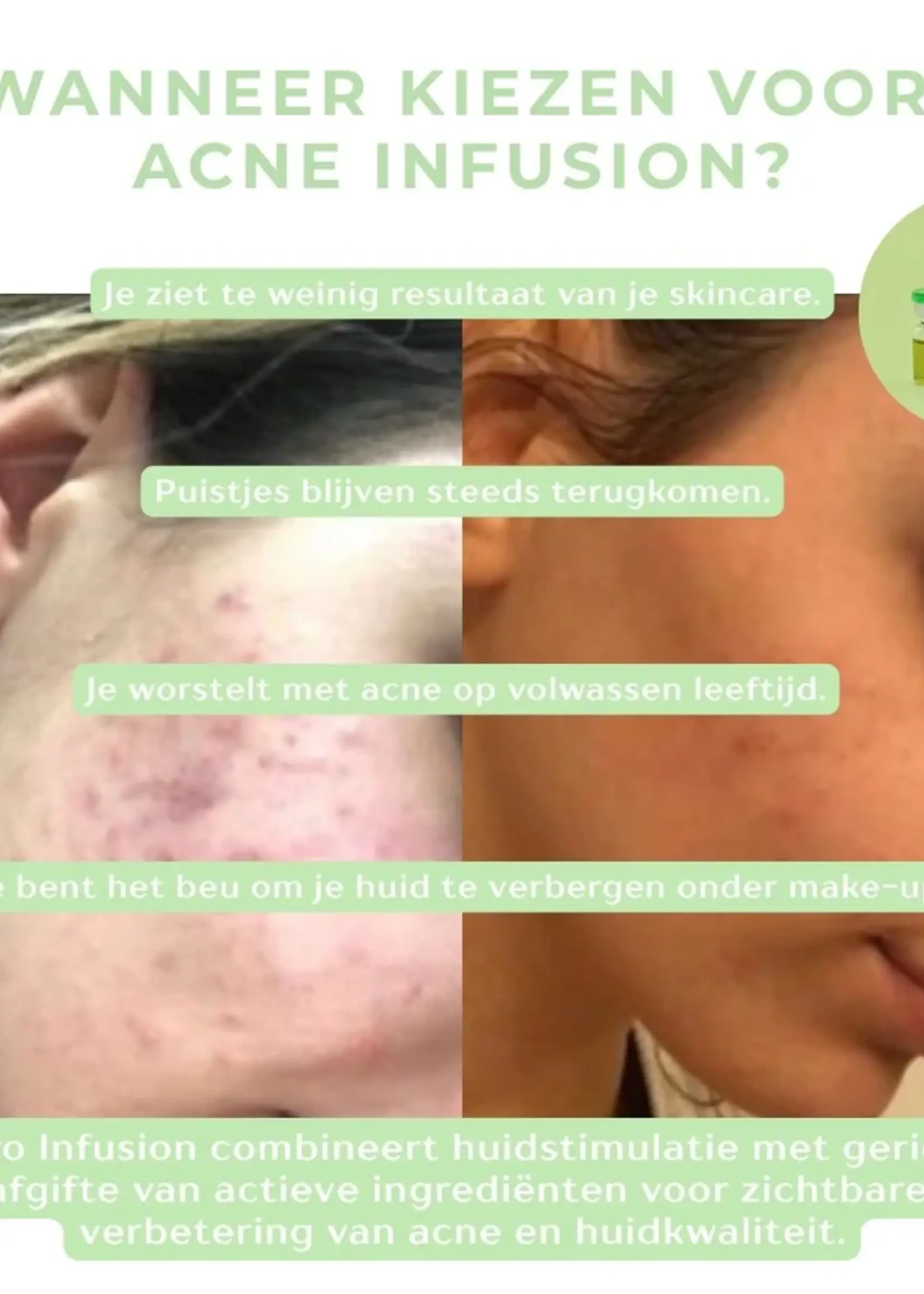 DermaLab Acne Infusion