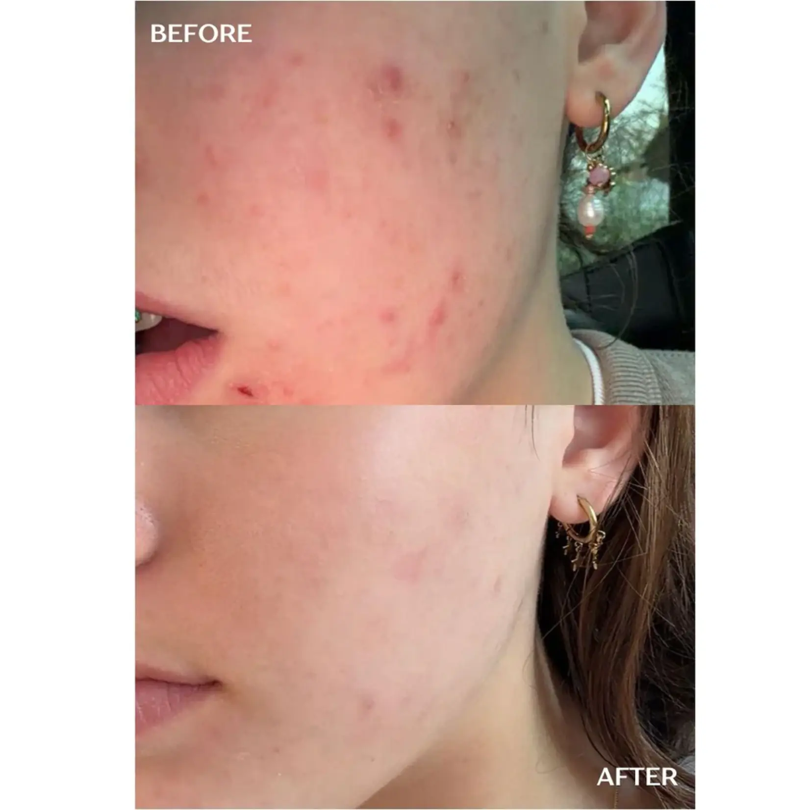 DermaLab Acne Infusion