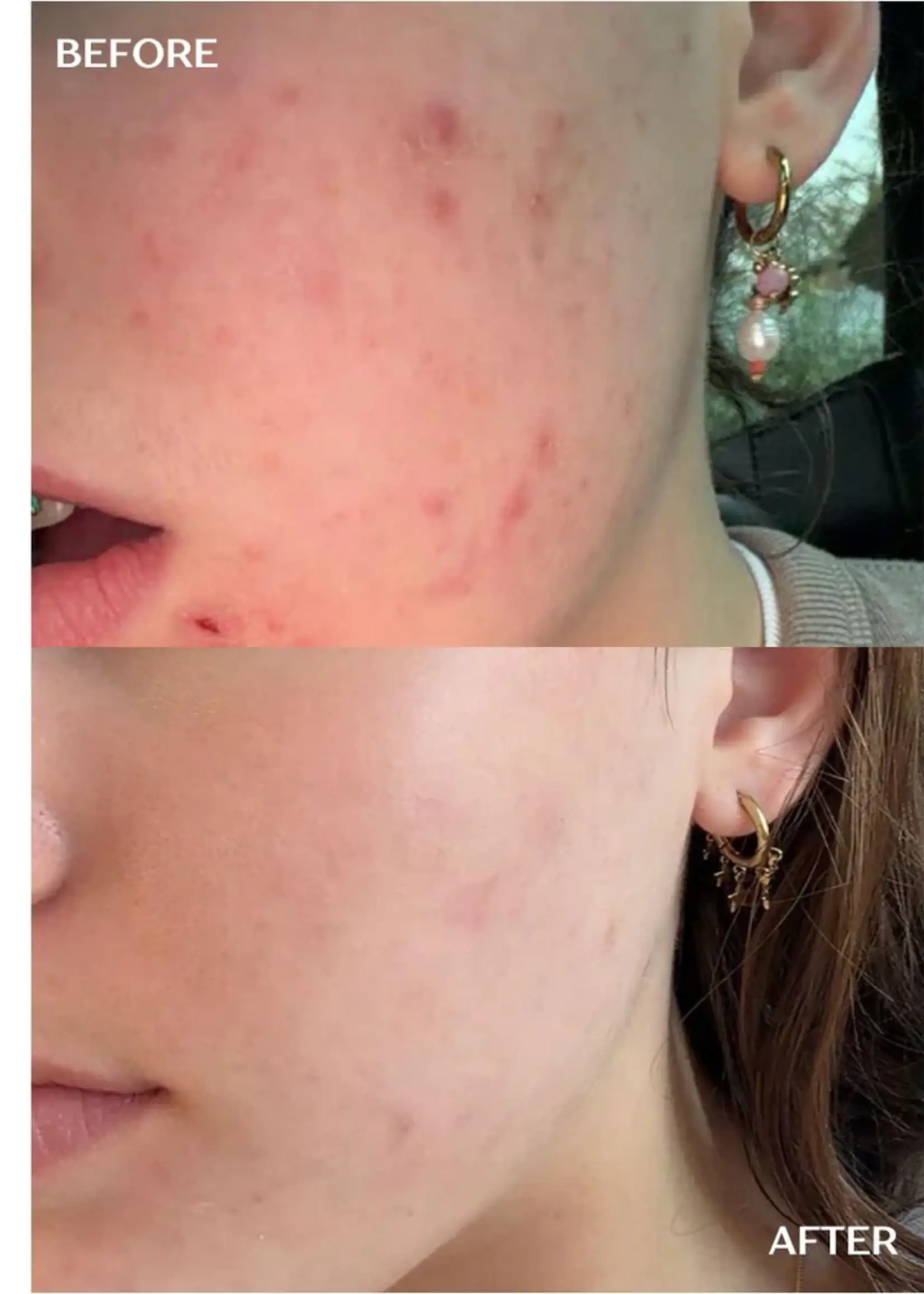 DermaLab Acne Infusion