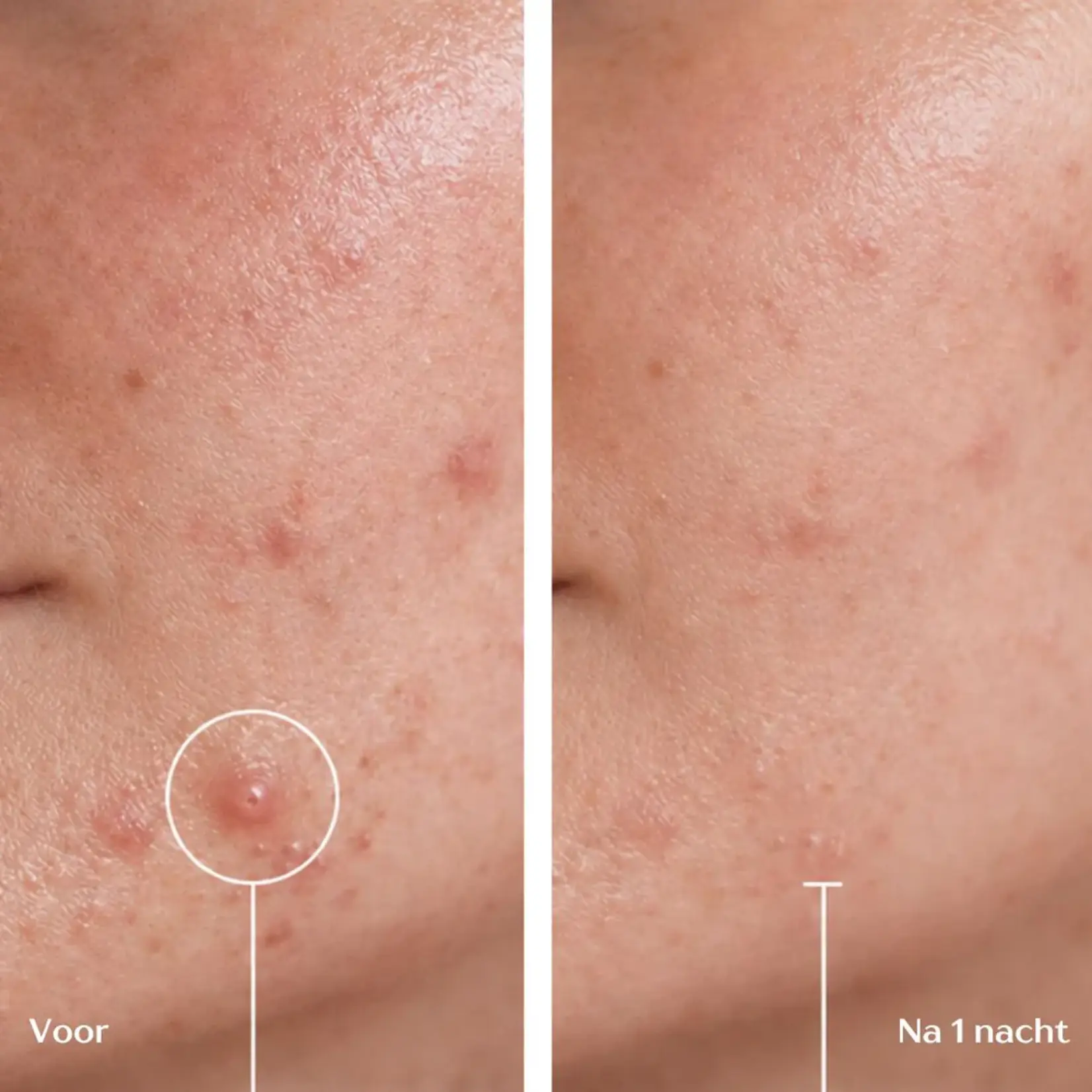 DermaLab Acne Micropatches
