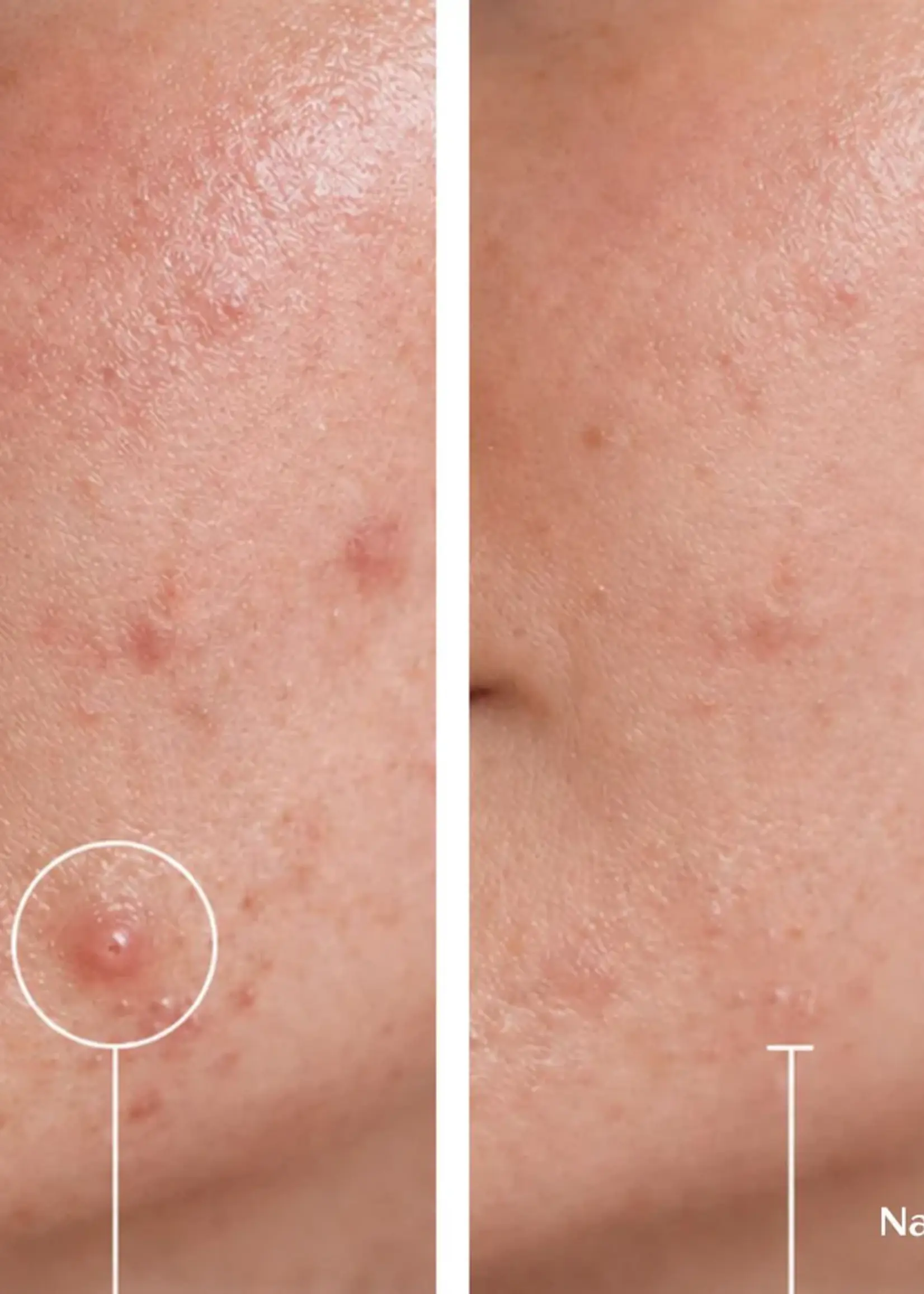 DermaLab Acne Micropatches