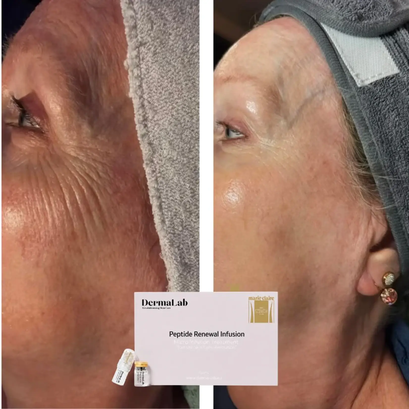 DermaLab Peptide Renewal Infusion: 3 maanden plan