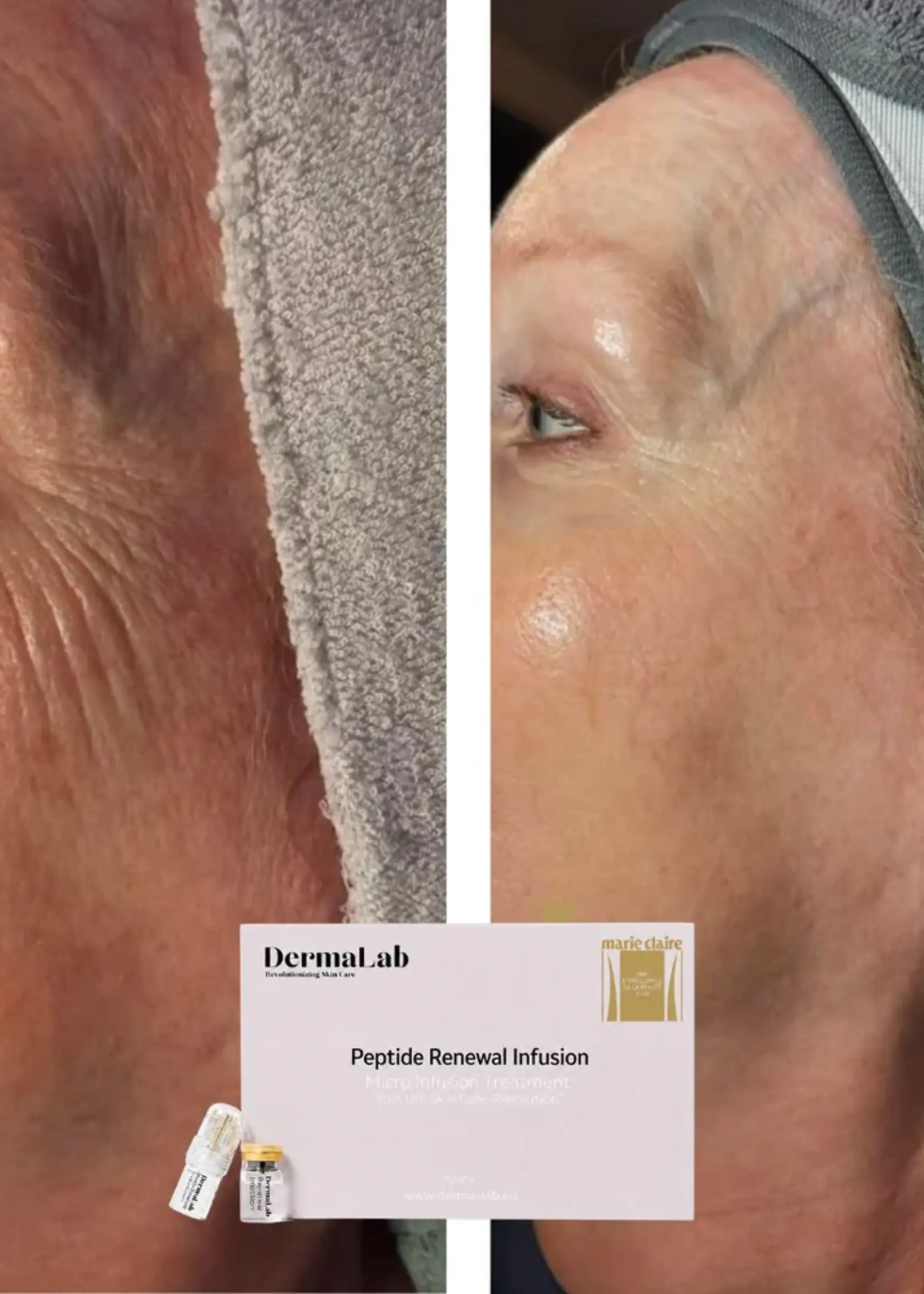 DermaLab Peptide Renewal Infusion: 3 maanden plan