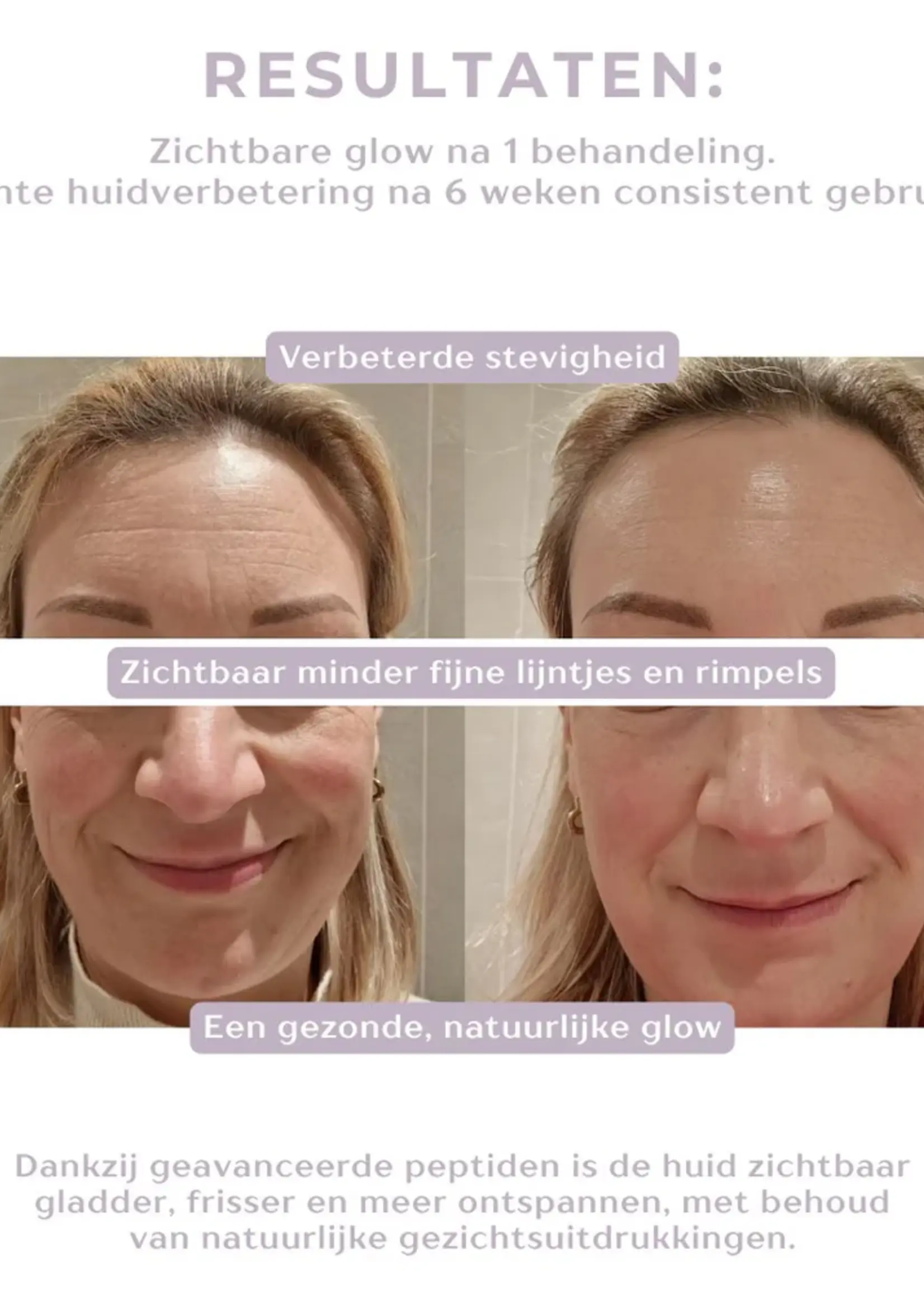 DermaLab Peptide Renewal Infusion: 3 maanden plan