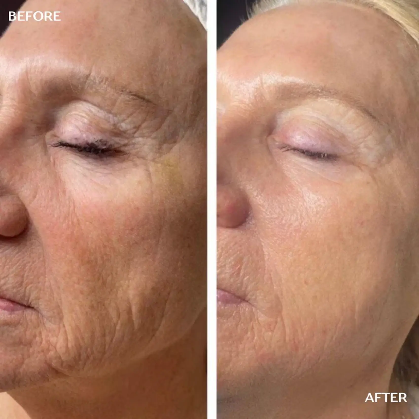 DermaLab Peptide Renewal Infusion: 3 maanden plan