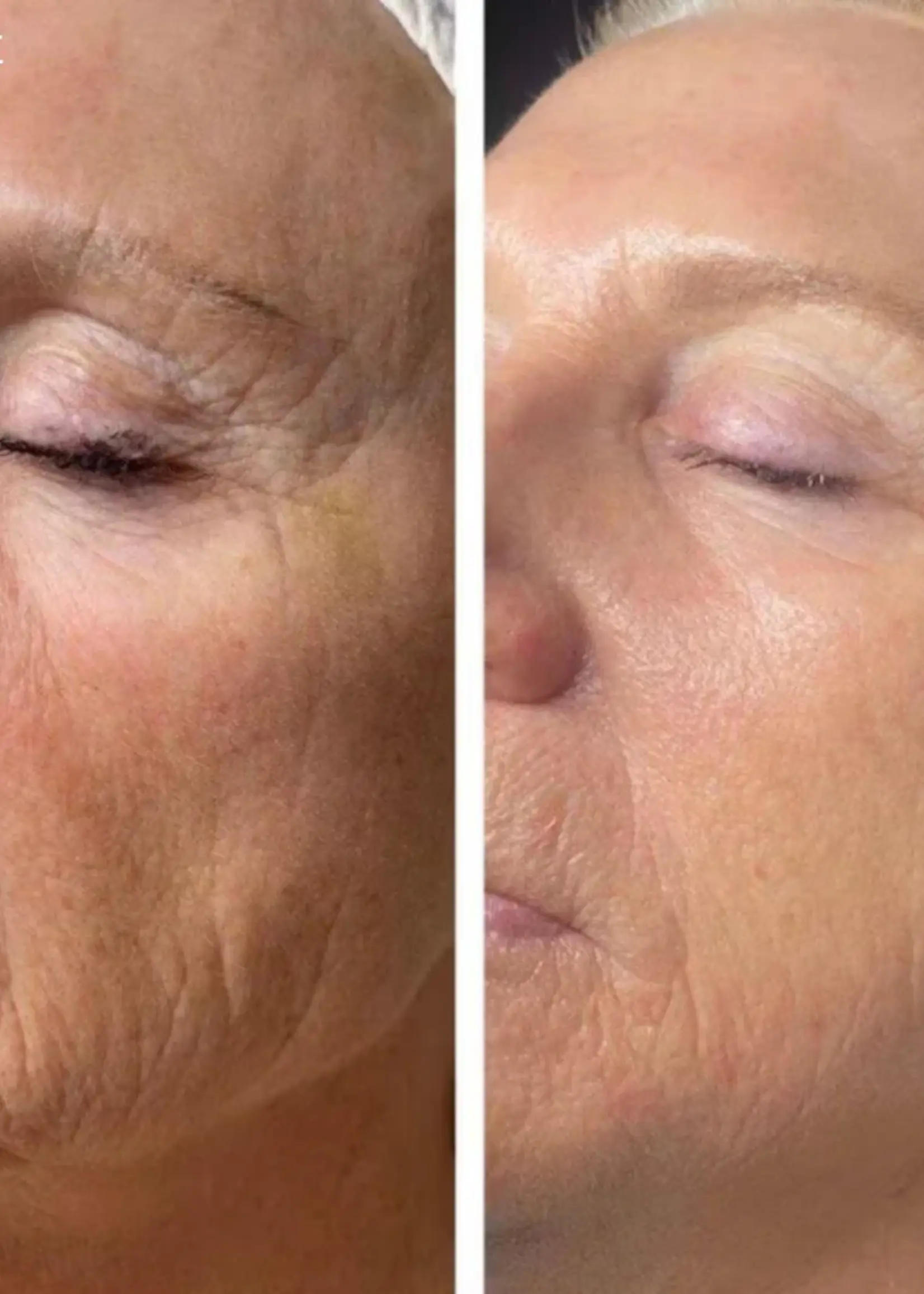 DermaLab Peptide Renewal Infusion: 3 maanden plan