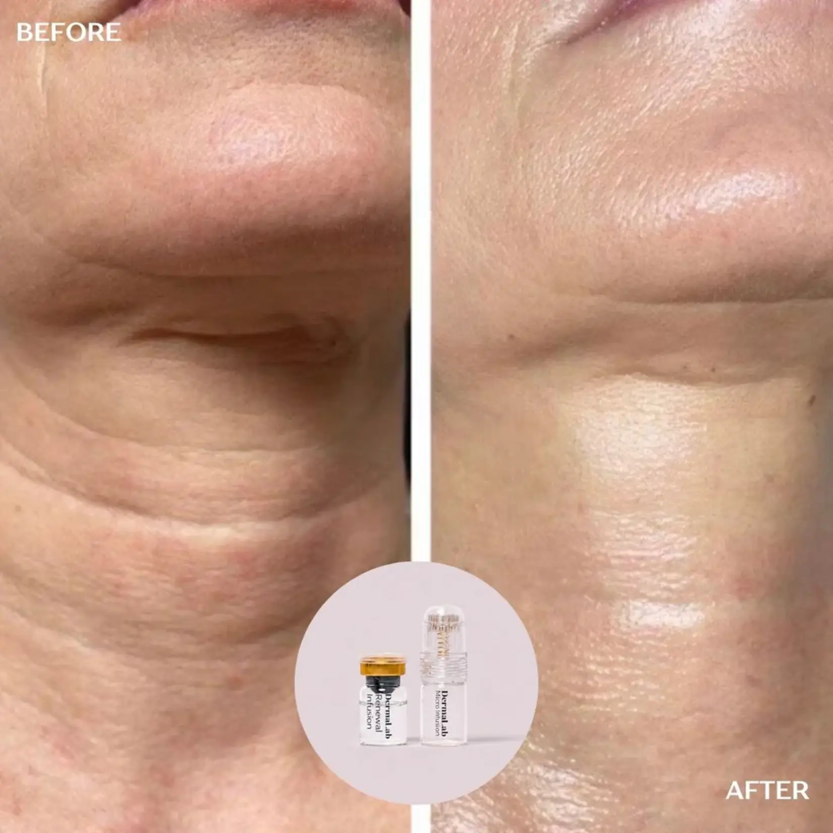 DermaLab Peptide Renewal Infusion: 3 maanden plan