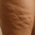 Cellulitis