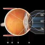 Volk 3-spiegel gonio fundus lens No Flange/Fluid AR coating
