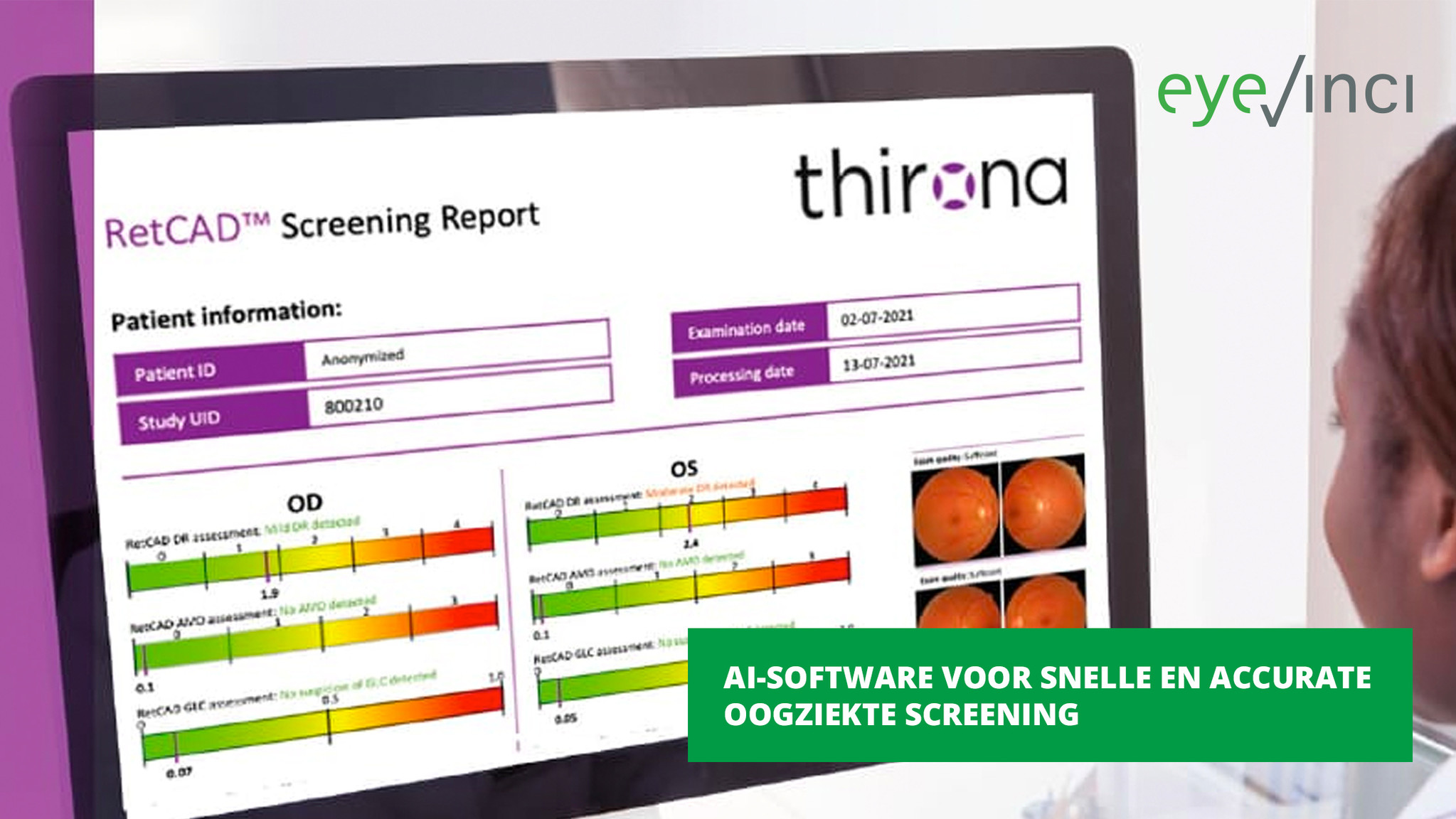 AI-software voor snelle en accurate oogziekte screening