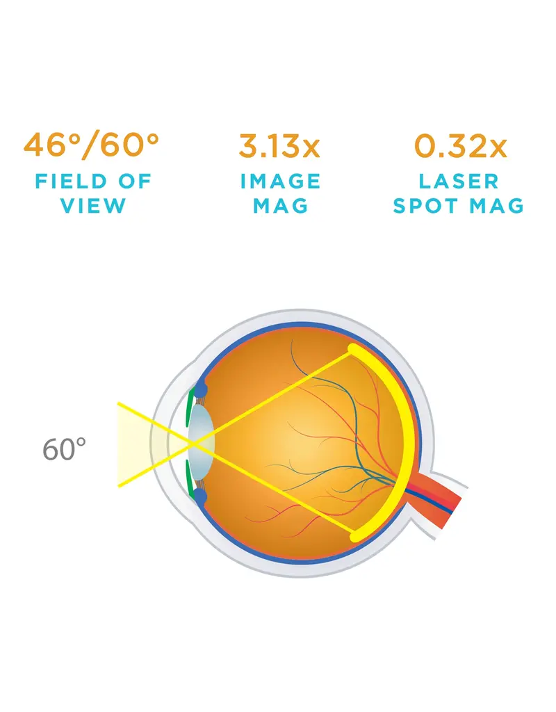 Volk Volk 60D Dubbel Asferische Ophthalmoscopielens – Retina & Macula onderzoek