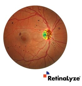 RetinaLyze RetinaLyze abonnement per maand, snelle AI-analyse van fundusfoto's en OCT-scans