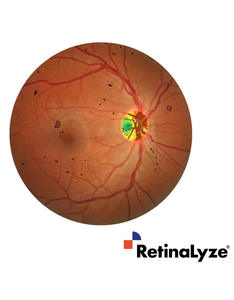 RetinaLyze RetinaLyze abonnement per maand
