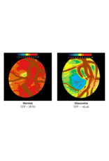 RetinaLyze RetinaLyze abonnement per maand