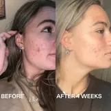 ROUTINELY | 07 360° AZELAIC ACID SERUM