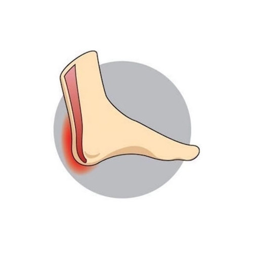 Achilles Tendonitis