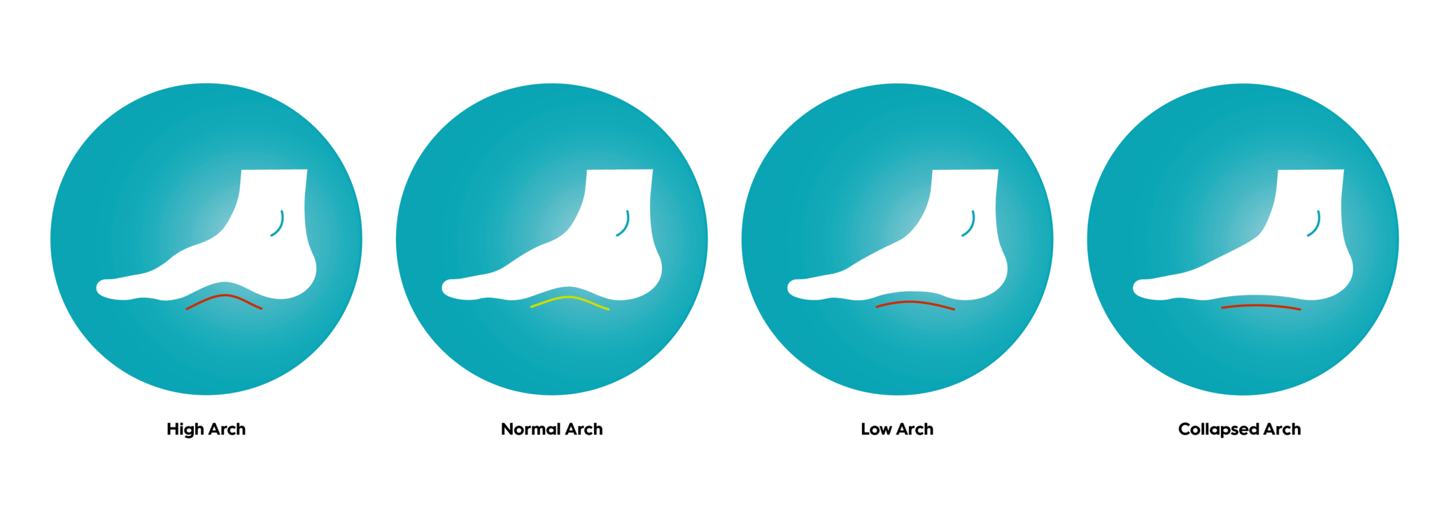 types of foot arches