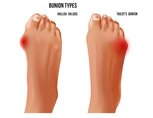 Step-by-Step Instructions for Treating Bunion Pain with Insoles ...