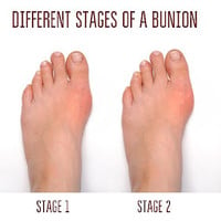 Is Buying A Bunion Brace Worth The Cost?