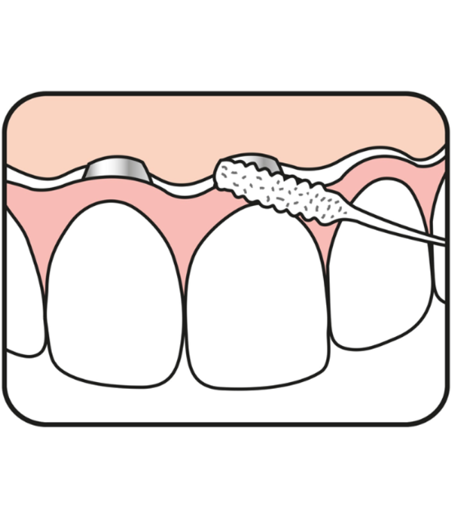 TePe Bridge & Implant Floss 30 stuks