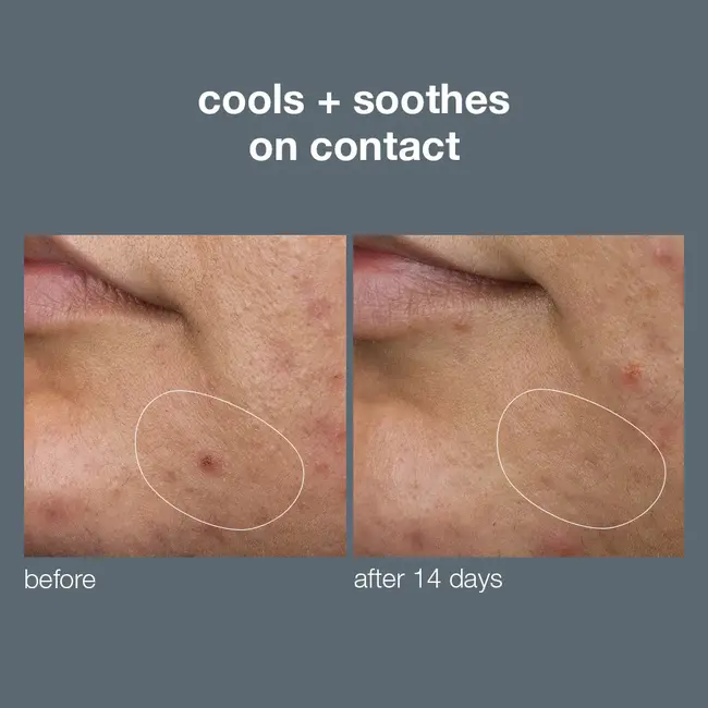 Dermalogica Deep breakout liquid patch