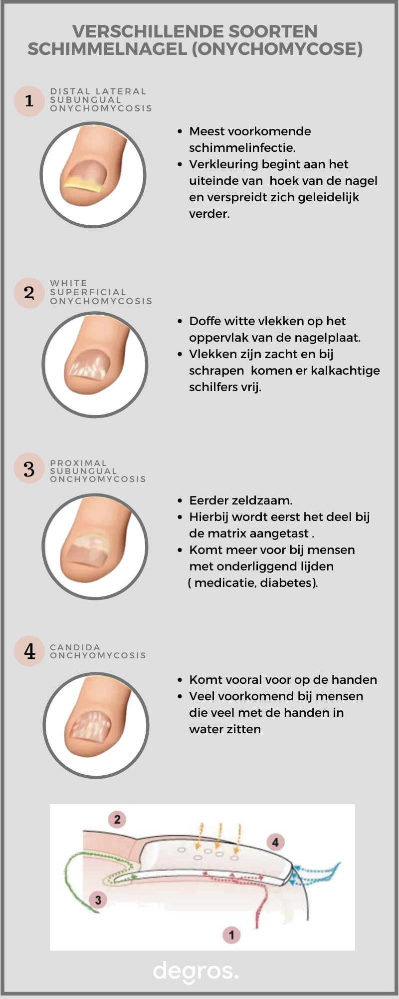 Veel mensen hebben er in hun leven wel eens last van, soms is het zelfs een terugkerende kwaal. Een kalknagel is niet gevaarlijk voor de gezondheid, maar het ziet er natuurlijk niet zo fijn uit.