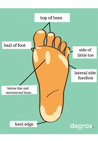 Common areas of callus on the foot