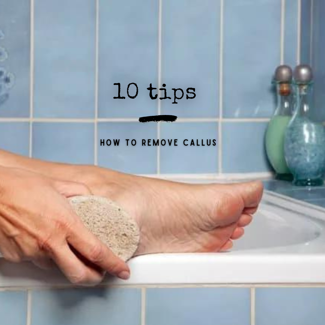 Remove calluses; 10 tips to make and keep your feet free of callus!