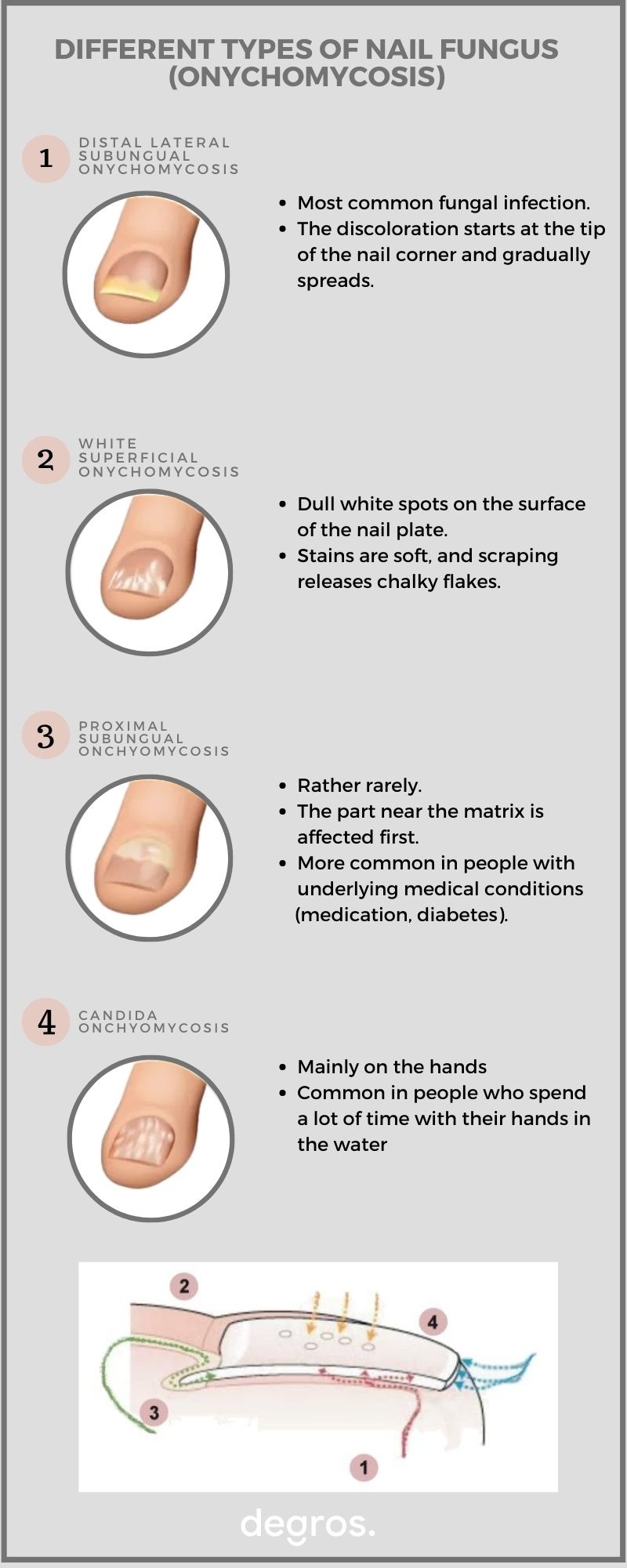 different types of nail fungus