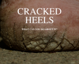 Suffering from cracked heels? With these 10 tips you can get rid of it!