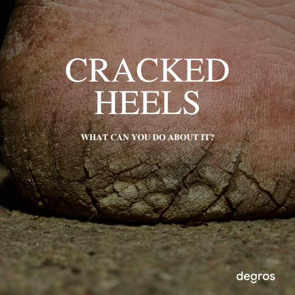 Suffering from cracked heels? With these 10 tips you can get rid of it!