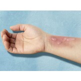 Detectaplast Burn Gel 118ml (6 stuks)