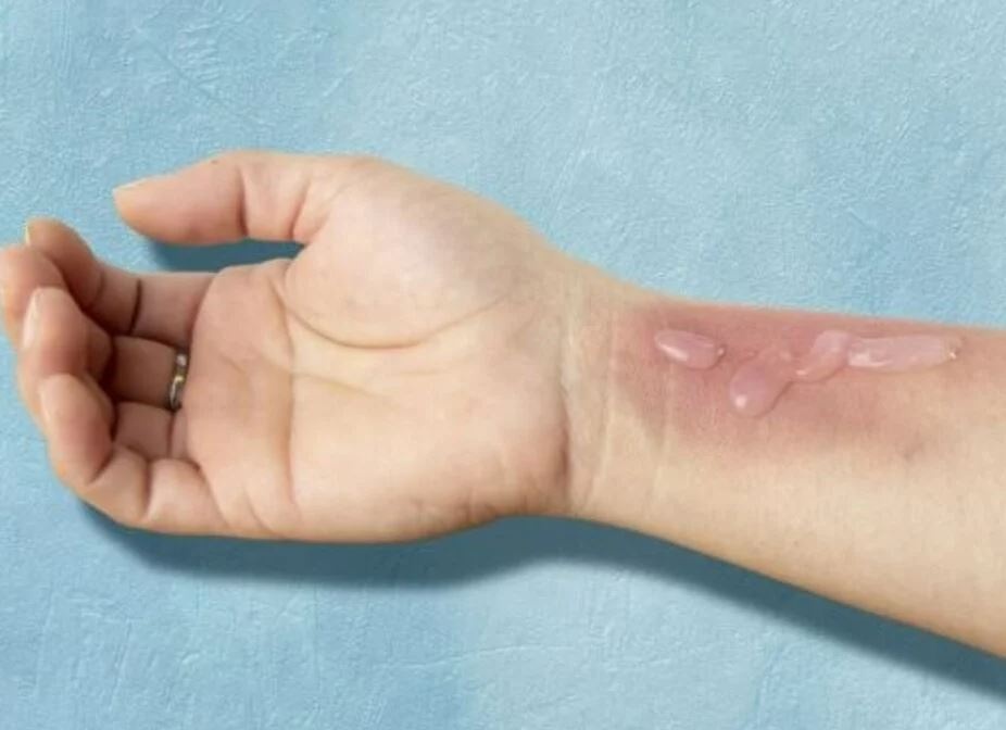 EHBO bij brandwonden: 4 Essentiële stappen voor een snelle genezing