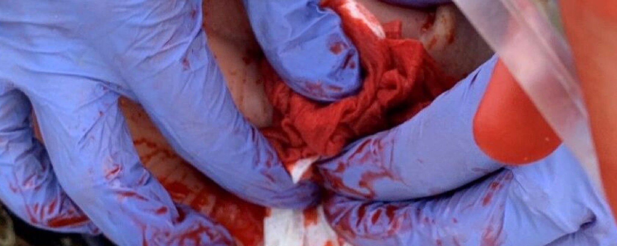 6 Essentiële stappen bij Acute levensbedreigende bloedingen