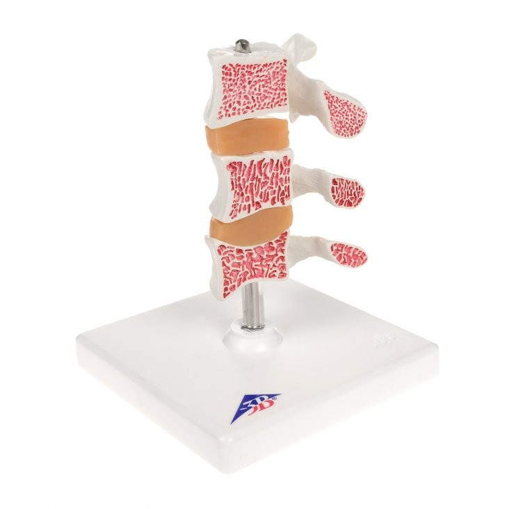 DeLuxe Osteoporosis Model (A78)
