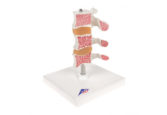 DeLuxe Osteoporosis Model (A78)