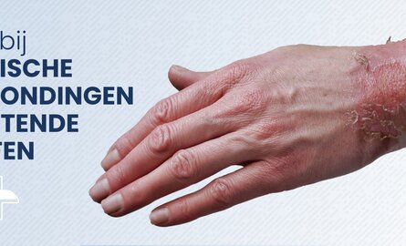 EHBO bij chemische verwondingen en bijtende stoffen