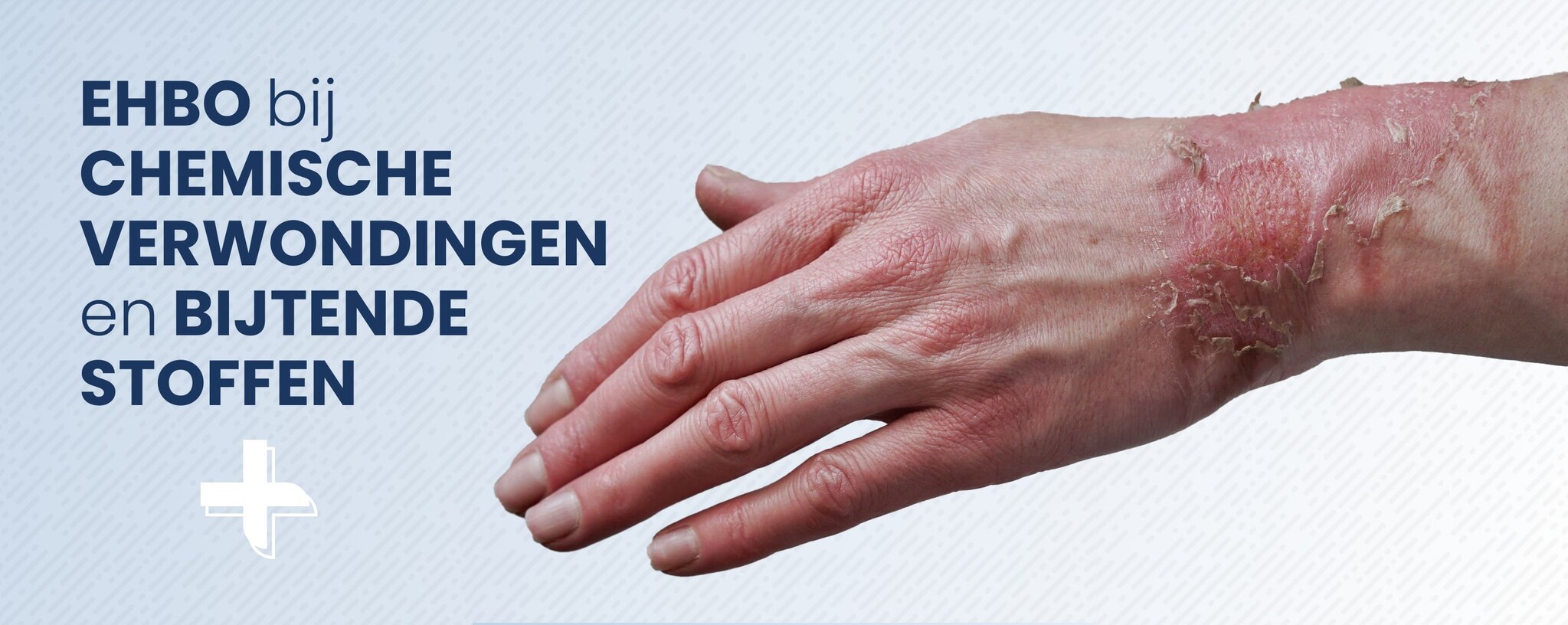 EHBO bij chemische verwondingen en bijtende stoffen