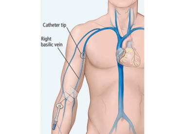 Kimal MIDLINE Catheter