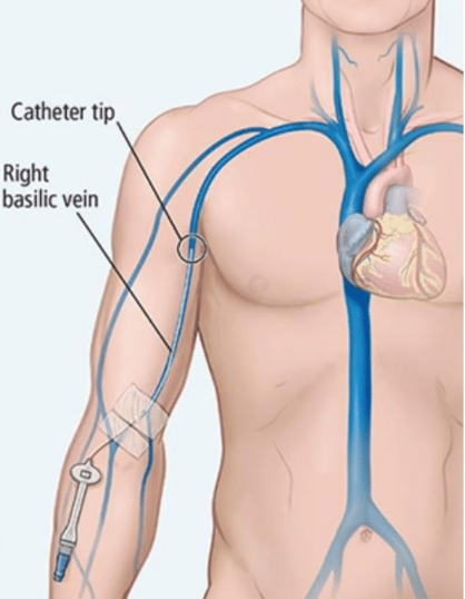 MIDLINE Catheters