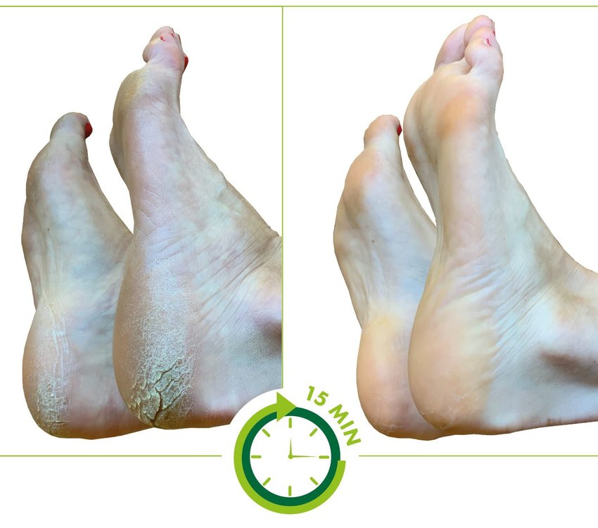 Mavex Calluspeeling Vegetal  10pk