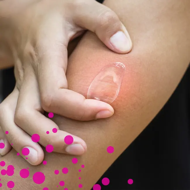 EMCUR Insectenbeet Noodhulp 20 ml